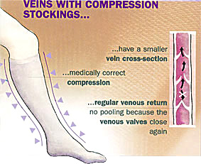 Compression Stockings for Leg Veins: Effective Treatment?