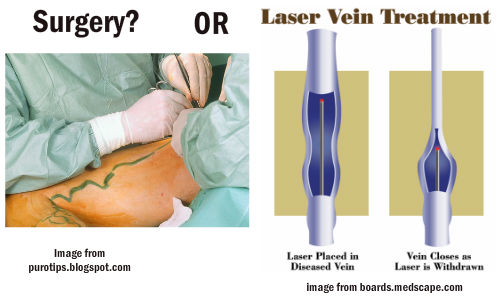 Varicose Veins Surgery: Purpose, Procedure, Benefits and Side Effects