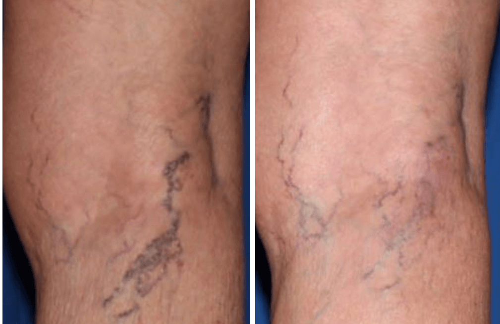 How To Get Rid Of Spider Veins Vein Specialists Of The South