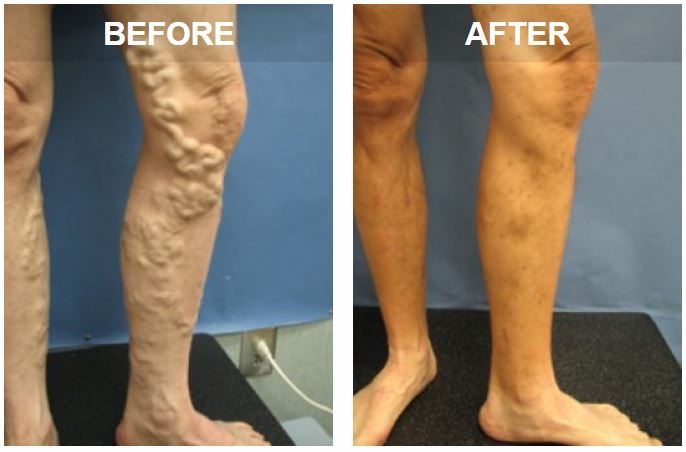 varicose-veins-symptoms-treatment-vein-clinic-perth