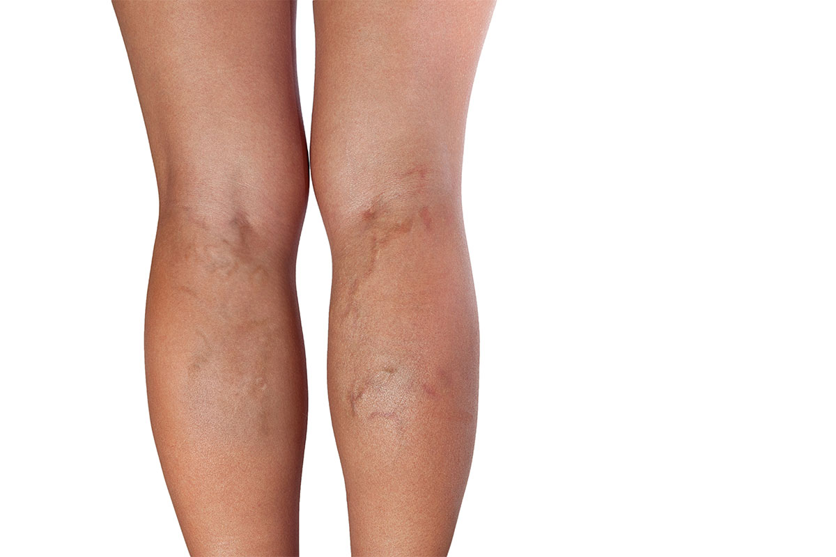 Canva—varicose Veins Of Woman Legs Vein Specialists Of The South
