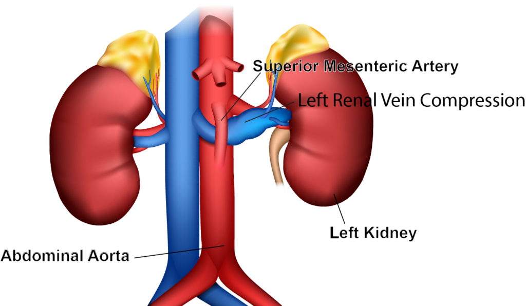 Nutcracker Syndrome 2 Vein Specialists of the South